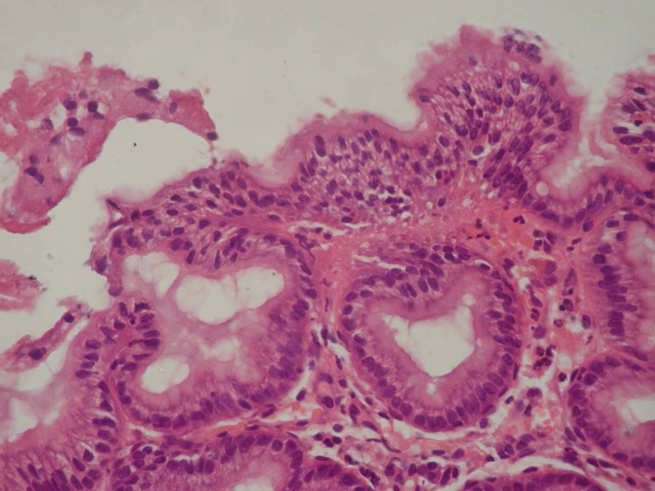 Papillomatous gastric ridges in patients with CTD