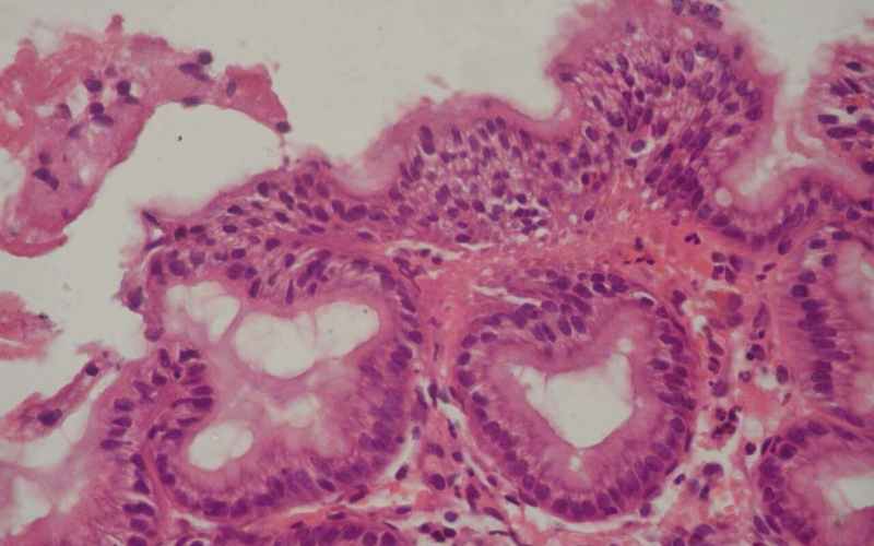 Papillomatous-gastric-ridges-in-patients-with-CTD-1