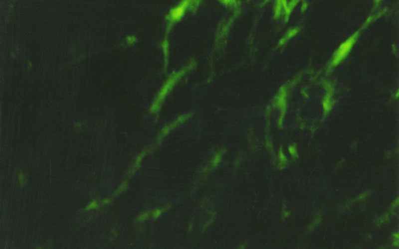 Type-I-collagen-of-gastric-mucosa-in-the-patient-with-CTD-1
